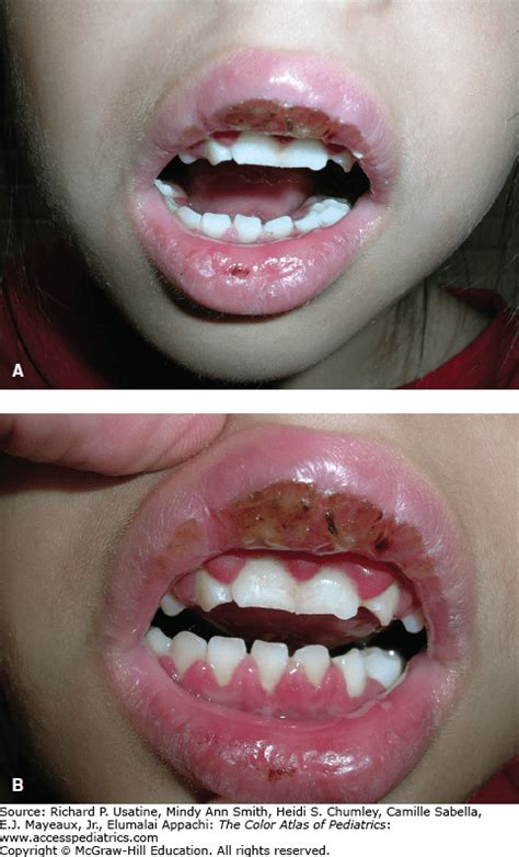 Herpetic Gingivostomatitis