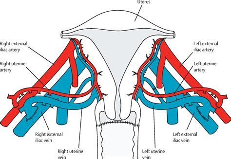 Livebirth After Uterus Transplantation The Lancet