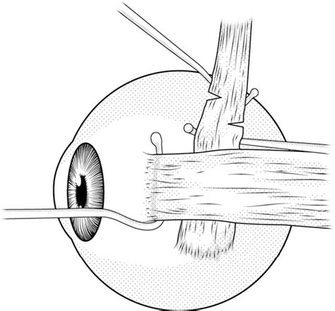 Figure From The Efficacy Of Superior Oblique Z Tenotomy In The