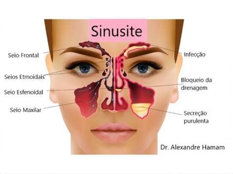 Sinusite Aguda Causas Sintomas E Tratamento