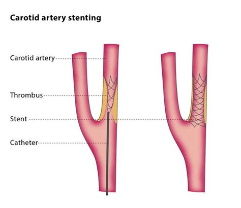 Carotid artery stenting – CIRSE