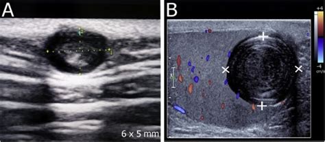 Overview Of Epidermoid Cyst European Journal Of Radiology Open