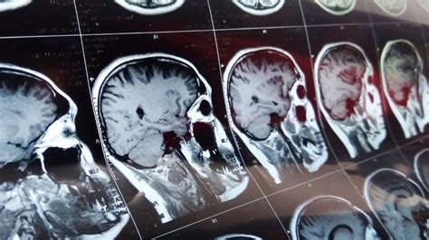 Cáncer De Cerebro Estas Son Siete Señales Para Estar Atentos Según