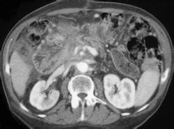 Recurrent Carcinoma Of The Pancreas With Vascular Invasion Pancreas