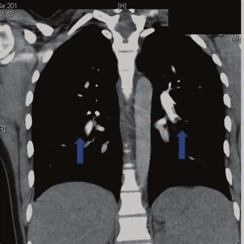 Ctpa Showing Bilateral Pulmonary Embolism Blue Arrow Shows