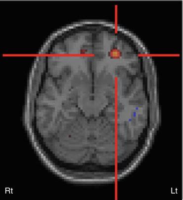 Radionuclide Imaging Studies in Pediatric Neurology | Radiology Key