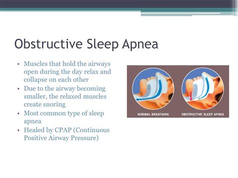 Ppt Sleep Apnea Powerpoint Presentation Id 6259697