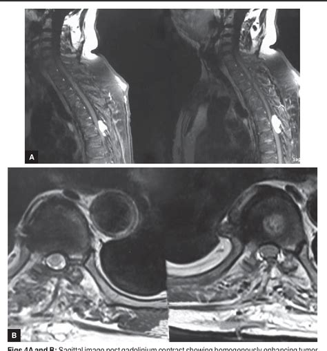 Figure 1 From A Rare Case Of Dumbbell Shaped Spinal Epidural Capillary