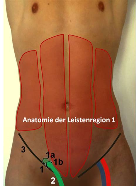 Anatomie Der Reparatur Von Leistenhernien