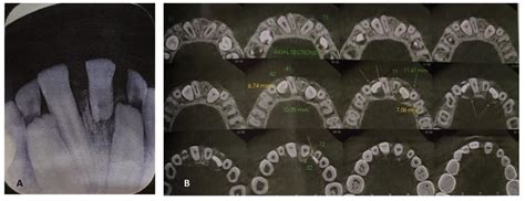 A An Intra Oral Peri Apical Radiograph Revealing Root Resorption Of