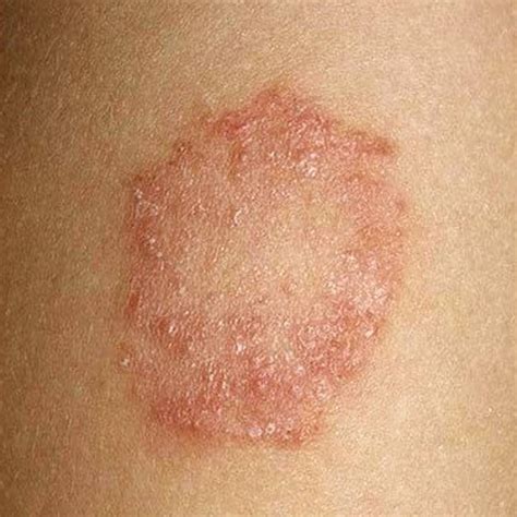 Tinea Corporis