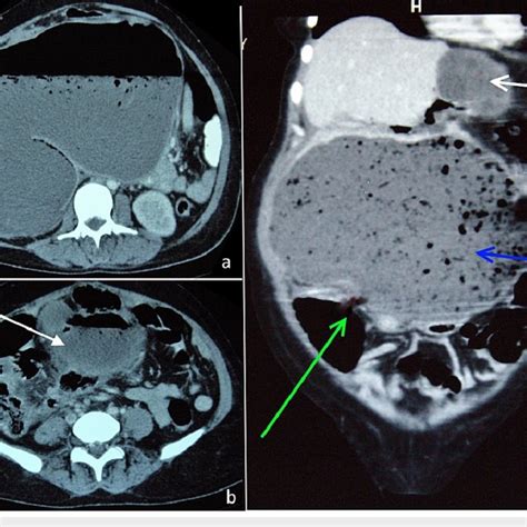 Cect Showing Multiple Hydatid Cyst In The A Liver And B Omentum Download Scientific Diagram