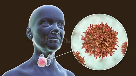 Thyroid Cancer Illustration Showing Tumor Inside Thyroid Gland And Closeup View Of Cancer Cells