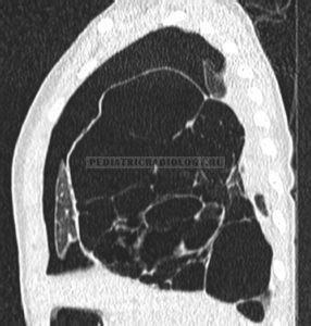 pleuropulmonary_blastoma_CT_sagital - Лучевая диагностика в педиатрии