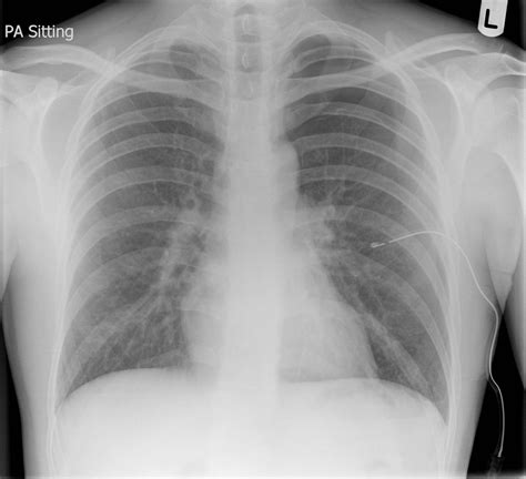Radiopaedia case Spontaneous pneumothorax id: 6122 study: 41837 - NC