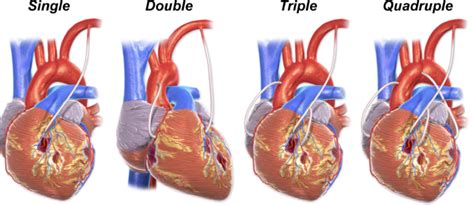 Triple Bypass Surgery Zollatry