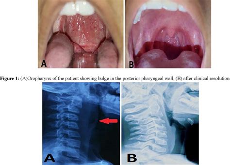 Figure 1 From Retropharyngeal Abscess As A Complication Of Cervical Spine Tuberculosis