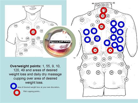 Overweight Need Cupping Done Wet Cup Red Points Plus Anywhere You