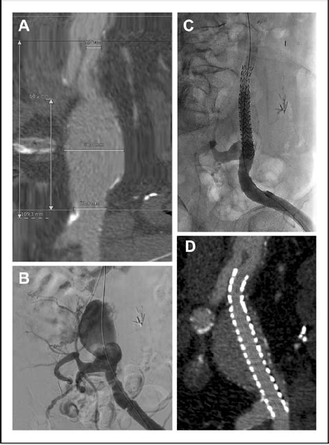 Figure 1 From Common Iliac Artery Aneurysm Repair Using A Sac Anchoring