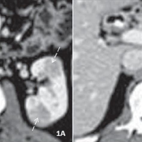 Axial contrast-enhanced CT scan of the abdomen, nephrographic phase. A ...