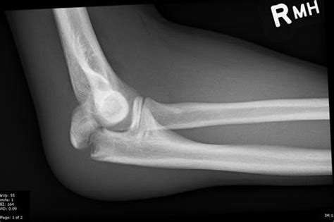 Olecranon Fracture - Physiopedia