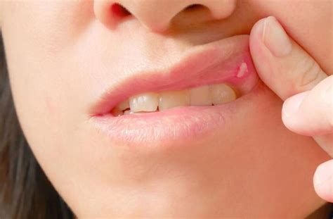 Oral Stomatitis Causes Types Of Stomatitis Prevention And Treatment