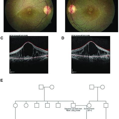 A B Color Fundus Photographs Of The A Right And B Left Eyes Of A