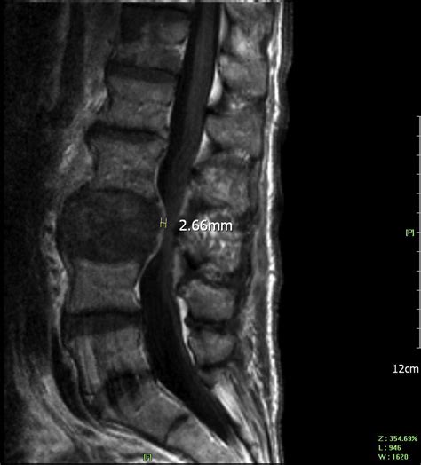 Bipolar Radiofrequency Ablation Of Spinal Tumors Predictability