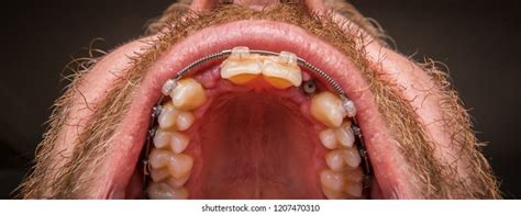 Stitch Jaw Surgery Images Stock Photos Vectors Shutterstock