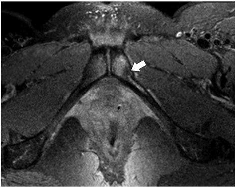 Pubic Bone Injuries In Primiparous Women Magnetic Resonance Imaging In