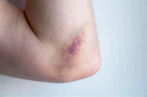 Premium Photo Closeup Of An Elbow With Big Bruise Hematoma Bruising