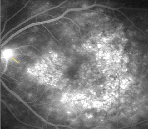 Diabetic Macular Edema Fluorescein Angiography