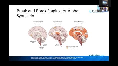 Weekly Webinar Dementia With Lewy Bodies 10 6 22 Youtube