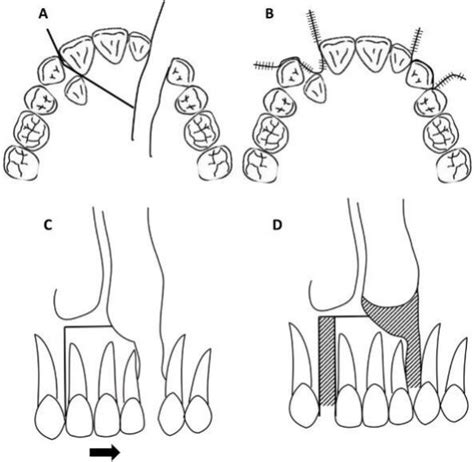 Diagram of this surgery: (A) Occlusal view showing the incision line ...