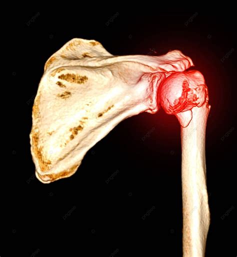 7 Fracture Head Of Humerus Photos, Pictures And Background Images For Free Download - Pngtree