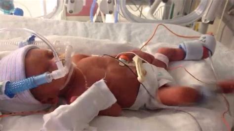 28 Week Preemie Sophia S One Year Journey YouTube