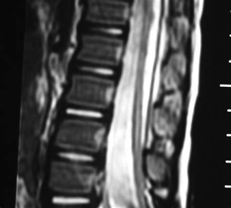 Myelomeningocele – Radiopaedia