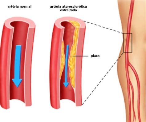 DoenÇa Arterial PerifÉrica Dr Raphael Prins