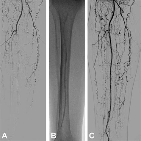 Miller Vein Cuff Venous Tissue Is Opened Longitudinally And Sutured In