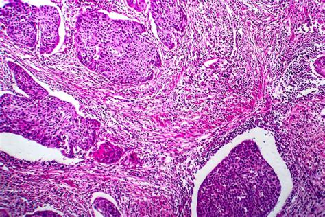 Carcinoma De C Lulas Escamosas De La Micrograf A De La Luz Del Tero