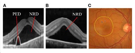 A Pigment Epithelium Detachment Ped And Neurosensory Retinal