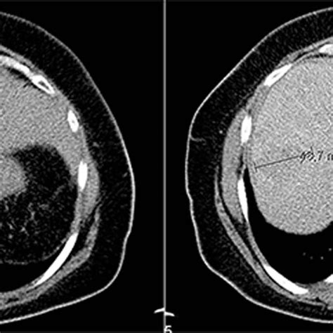 Computed Tomography Images Displaying A 4 7 3 4 6 Cm Tumor Showing