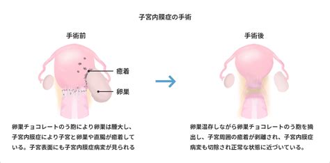 子宮内膜症｜婦人科｜四谷メディカルキューブ