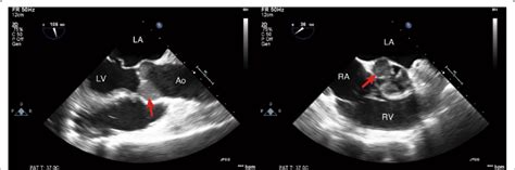 Mid Esophageal Aortic Valve Long Axis Left And Short Axis Right