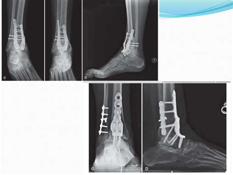 Ankle arthrodesis