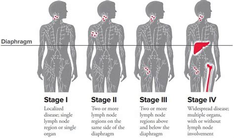 Lymphoma - Hodgkin & Non-Hodgkin Lymphoma - Survival Rate