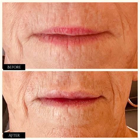 Natural Looking Results With Fillers At Direct Aesthetics