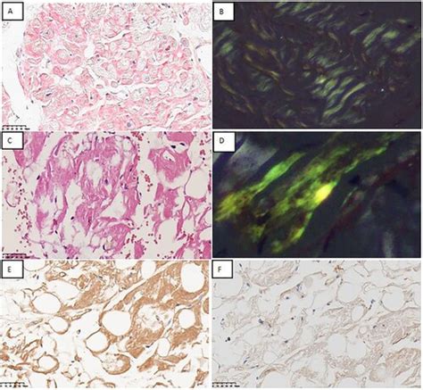 Full Article Strong Positive Light Chain Immunostaining In A Patient