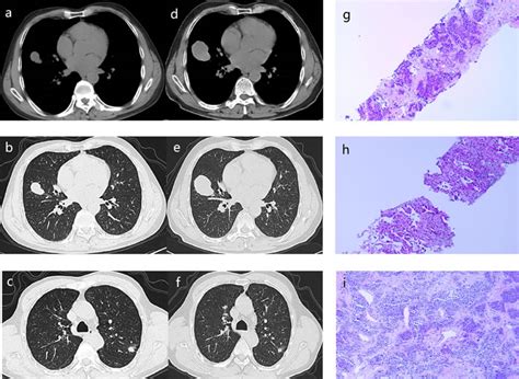 Multiple Primary Lung Cancer Displaying Different Egfr And Pten