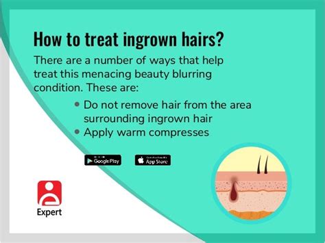 How To Treat Ingrown Hairs Find An Expert